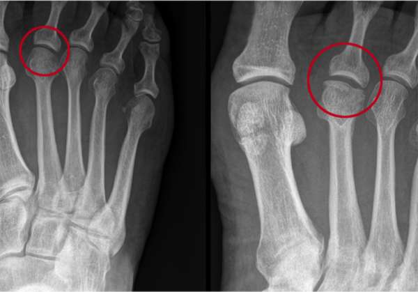 Las personas con el dedo gordo del pie más corto que el segundo dedo, tienen más riesgo de padecer la Enfermedad de Freiberg